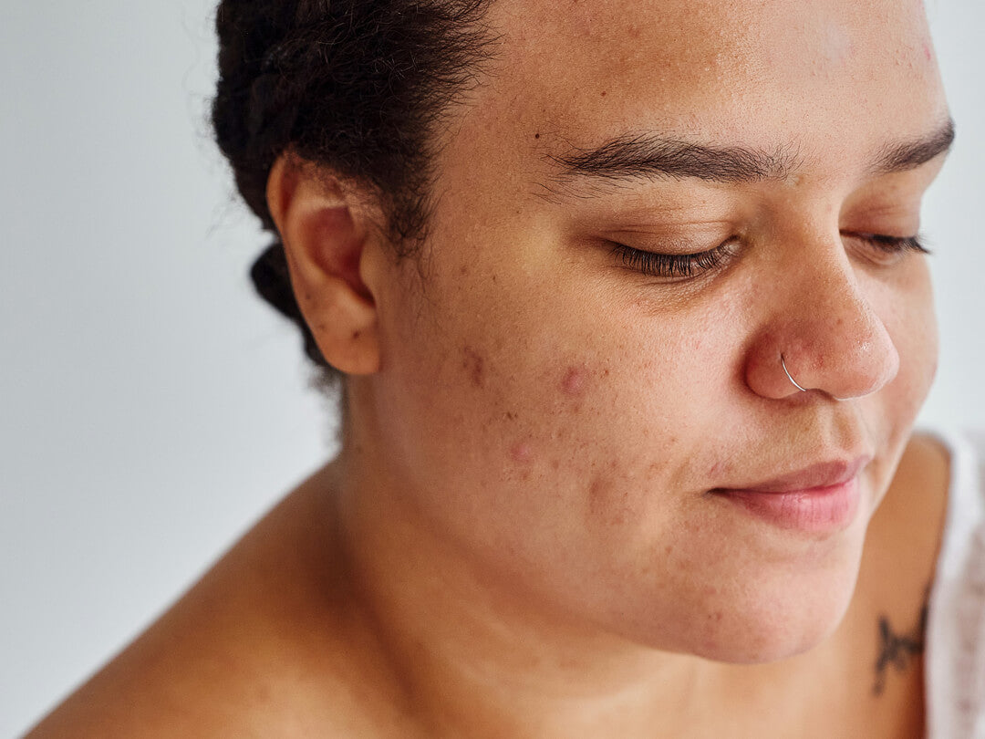 Mitesser entfernen | Five Skincare