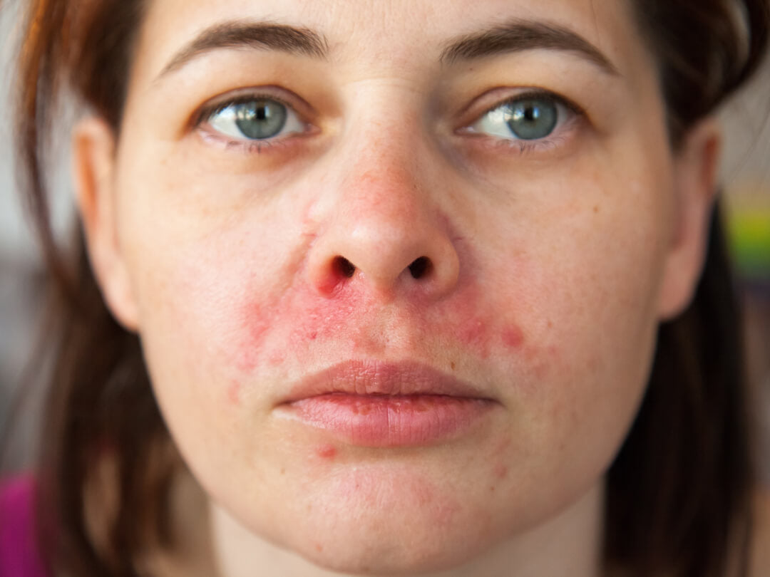 Gesicht einer Frau mit perioraler Dermatitis