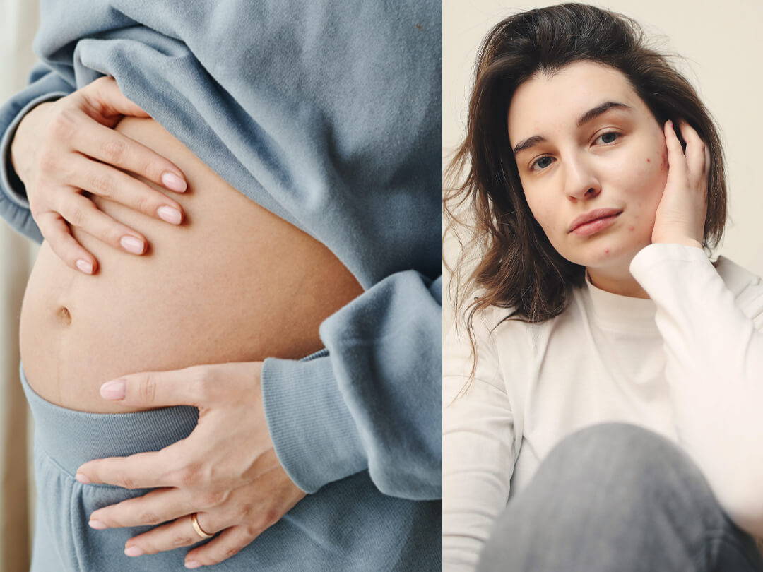 Pickel in der Schwangerschaft behandeln und vermeiden: 7 Tipps, die du kennen solltest!