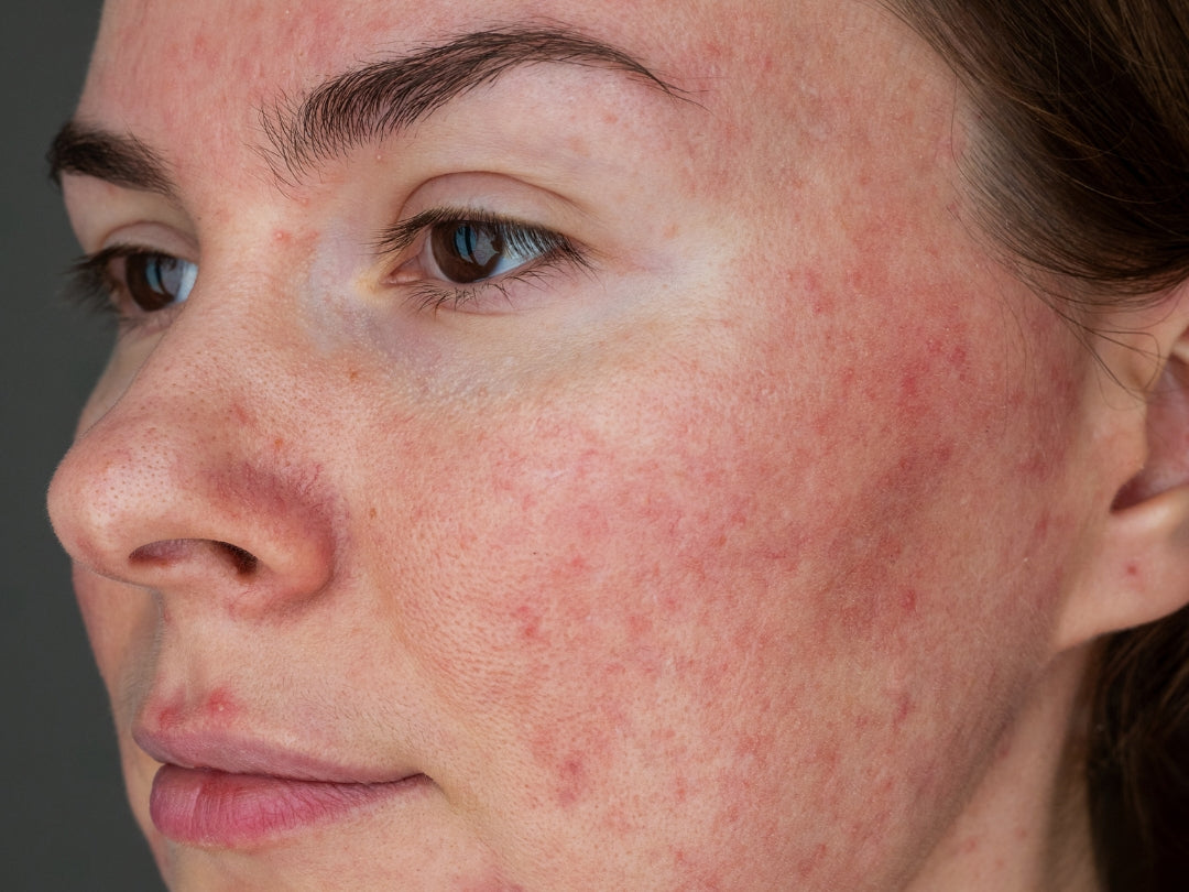 Rosacea